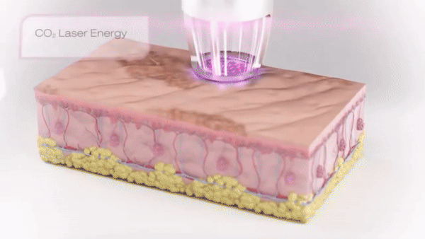4054b06435d41 CO2 레이저