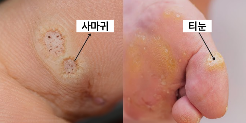 사마귀 제거 방법 사마귀 제거 방법
