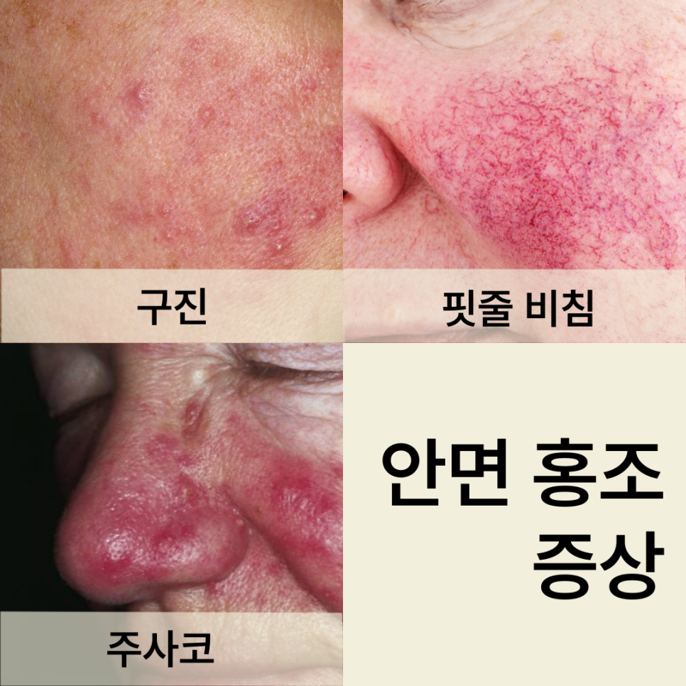 안면 홍조 증상 안면 홍조 증상