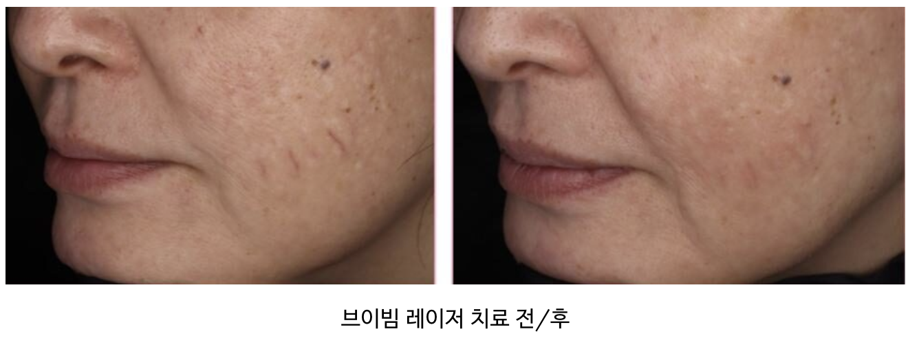 혈관 확장이 뚜렷한 경우