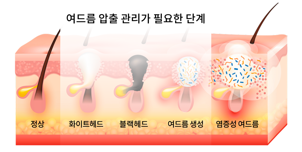 여드름 관리 프로그램