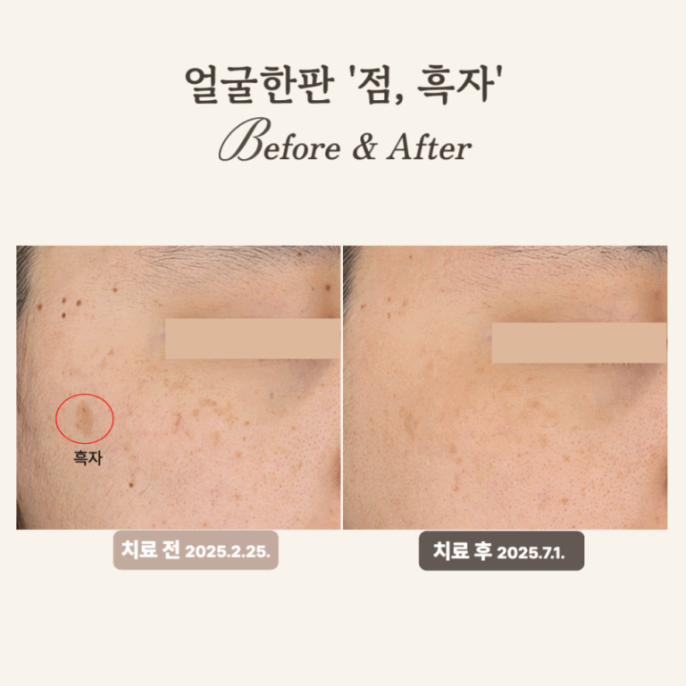 20대 얼굴한판 시술 후기: 점·흑자 제거 효과