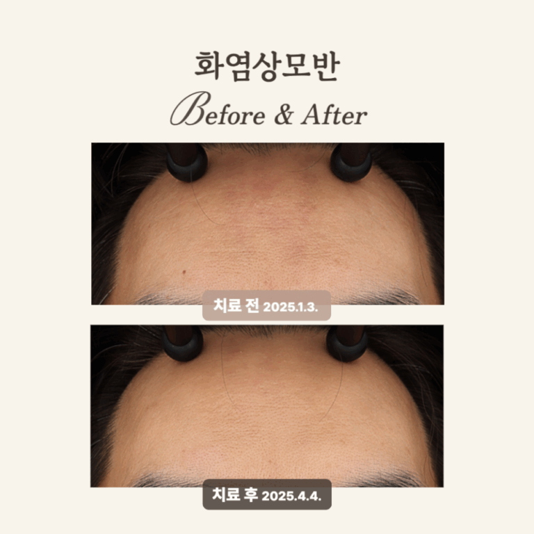 30대 이마 화염상모반, 3회 브이빔 후기