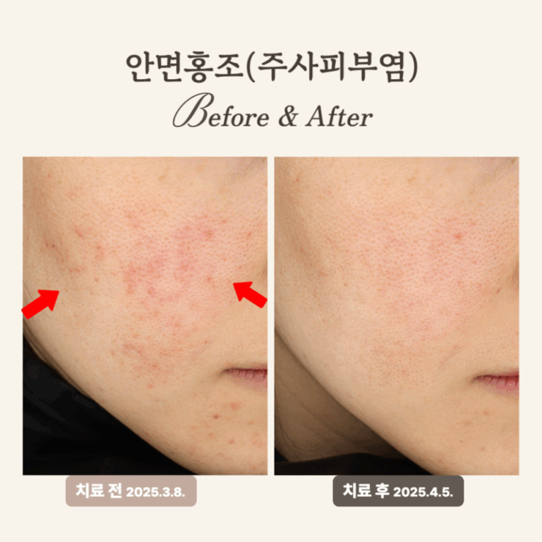 30대 주사피부염, 브이빔+PRP 2회 치료 후 홍조 개선 후기