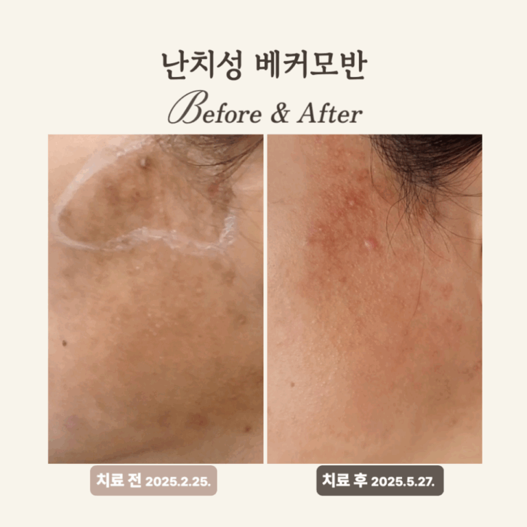 30대 베커모반 레이저토닝 치료 후기