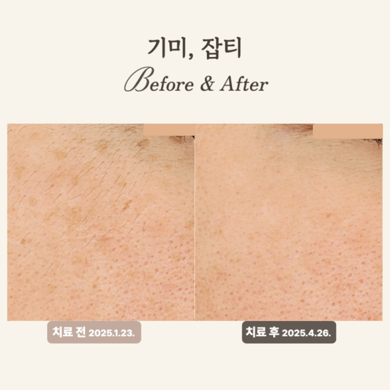 30대 눈 아래 잡티 개선, 피코토닝 듀얼토닝 후기로 확인하세요