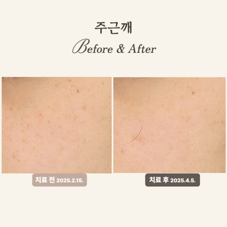 20대, 주근깨와 균일한 피부톤 위한 얼굴한판 치료 후기