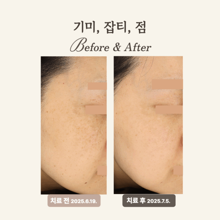 30대 혼합형 기미 레이저토닝 치료 후기