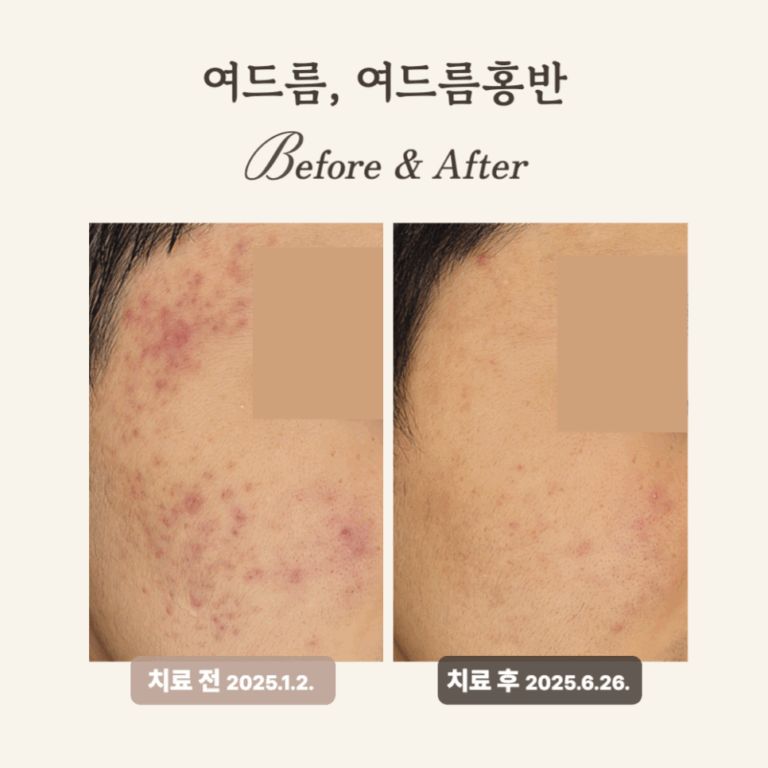 10대 여드름 고민? 브이빔레이저 치료 후기