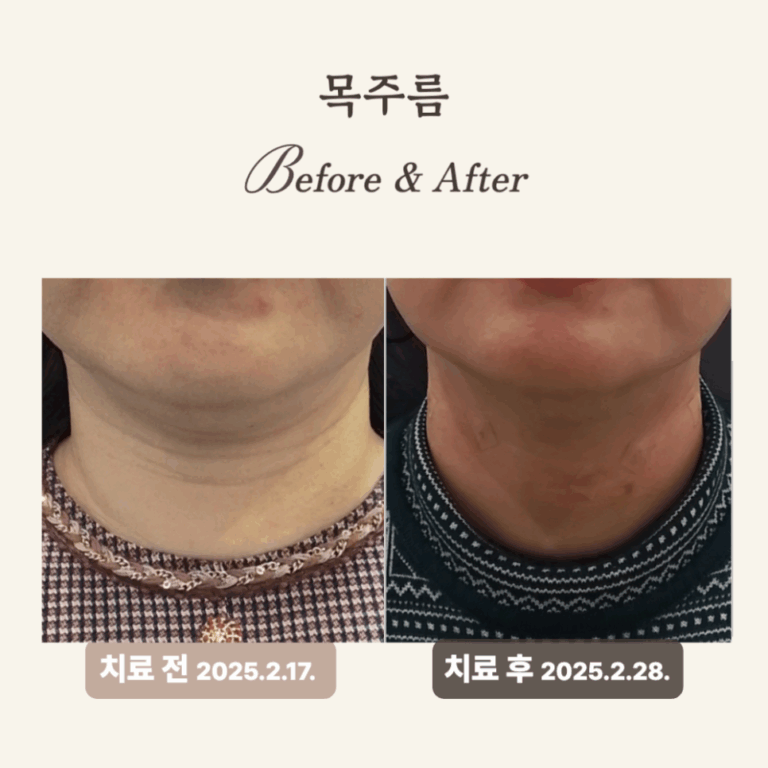 60대, 깊은 목주름 필러 시술 후기: 레디어스로 탄력 회복