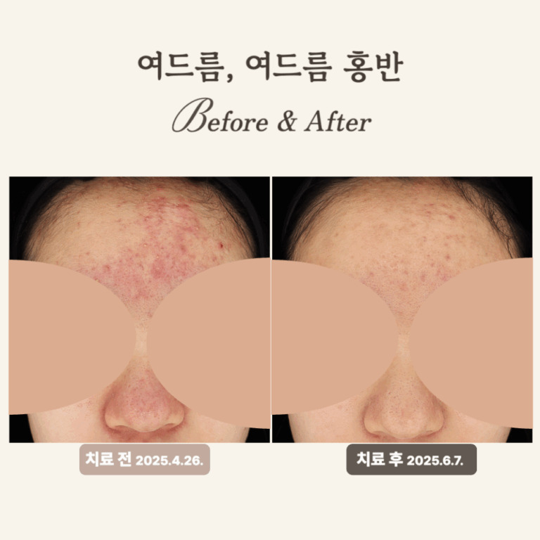 10대 여드름 치료 후기: 골드PTT와 브이빔 횟수별 효과는?