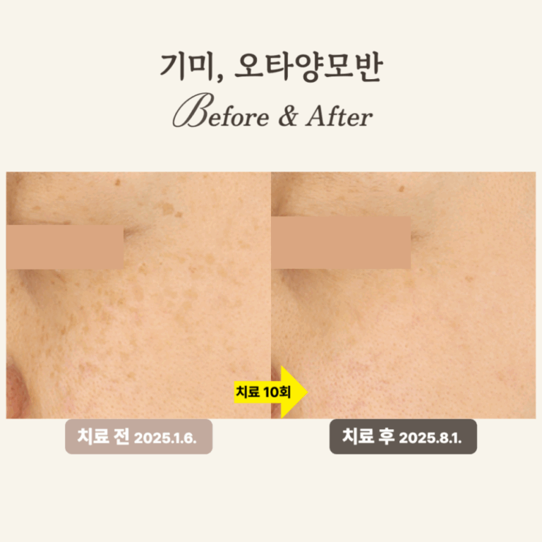 40대 레이저토닝 시술 후기: 칙칙함 개선과 오타양모반 제거