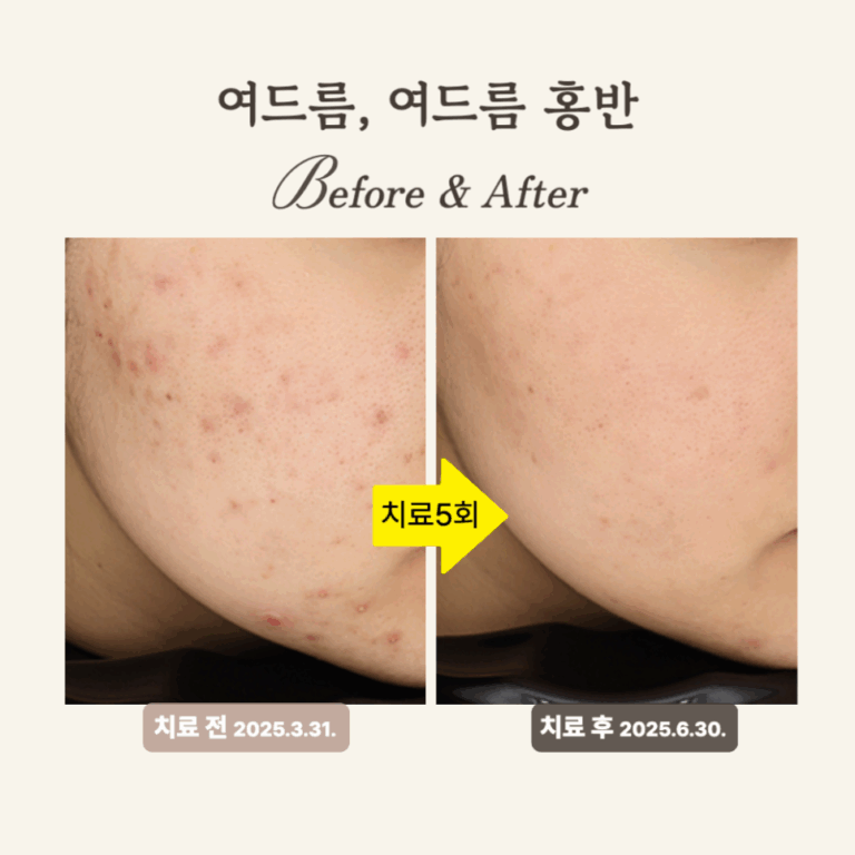 20대 여드름 압출 후 골드PTT와 브이빔레이저 치료 후기