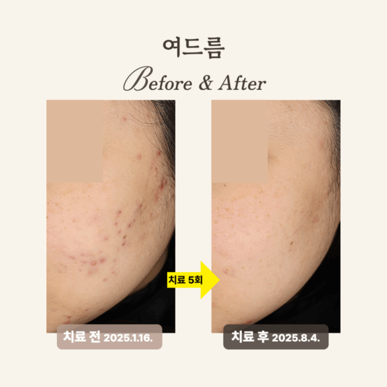 20대 골드PTT와 브이빔 시술 후기: 여드름과 홍반 개선