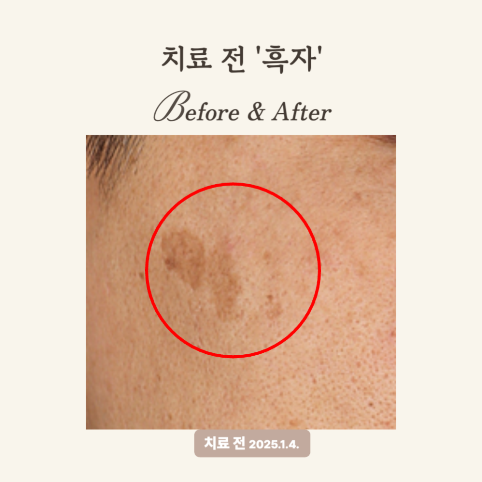 40대 얼굴한판 흑자 시술 후기