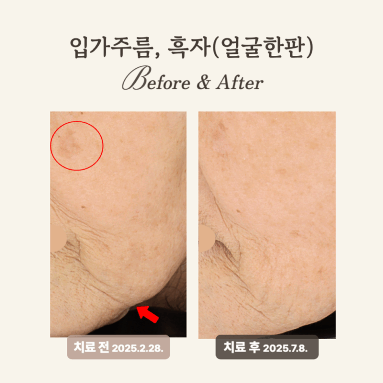 60대 깊은 주름과 탄력 개선, 얼굴한판 시술 후기
