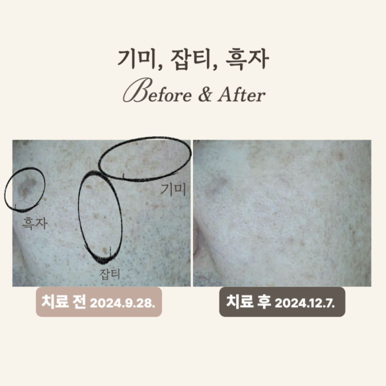 50대 잡티와 기미, 피코토닝 시술 후기