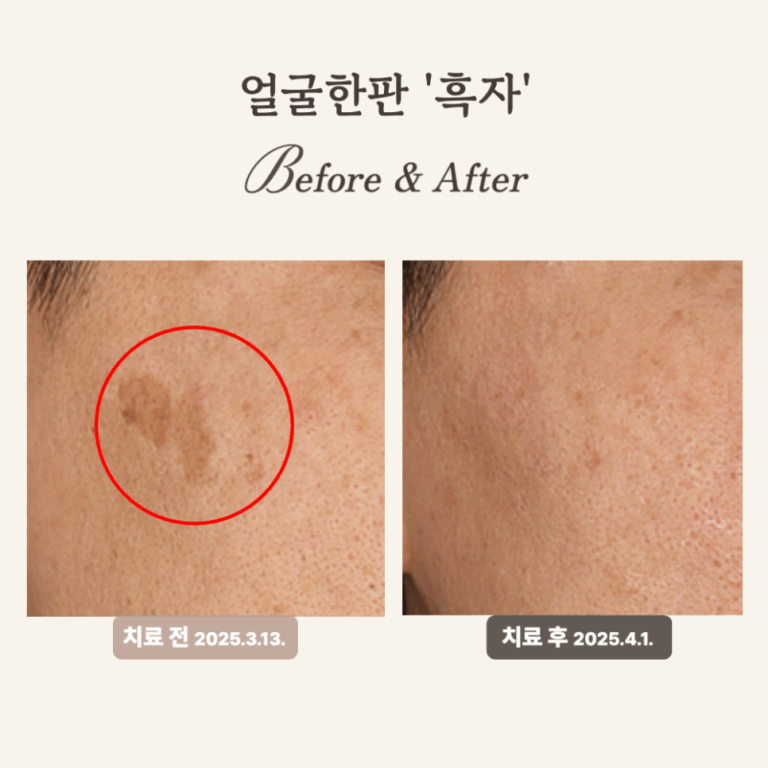40대 얼굴한판 흑자 시술 후기