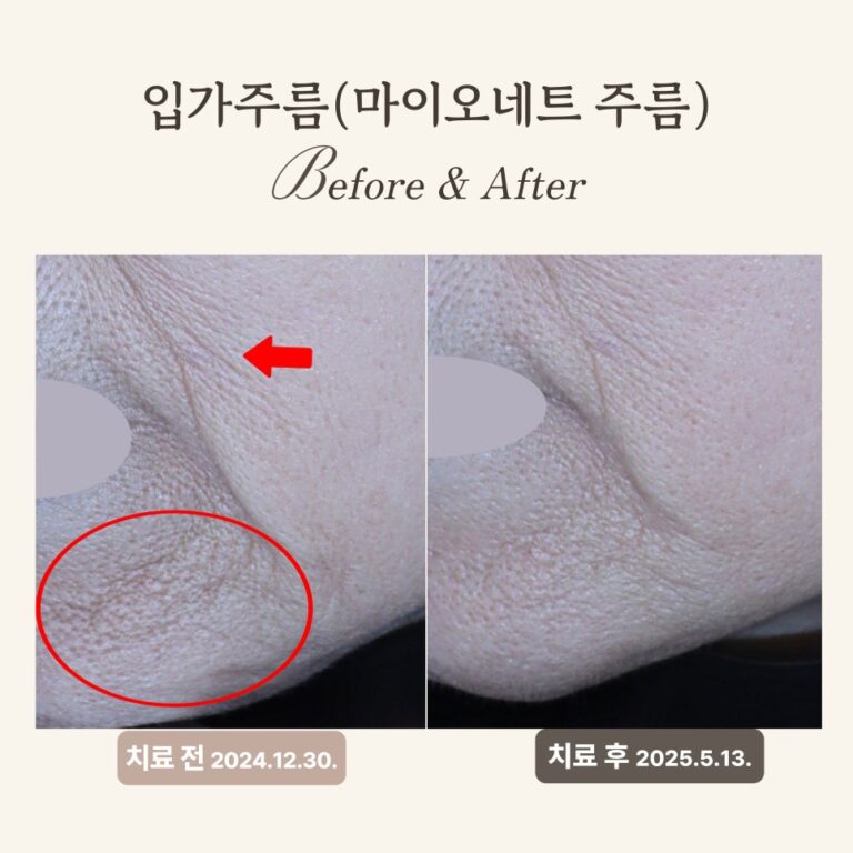 60대 써마지와 레디어스 시술 후기: 주름 개선 및 탄력 회복