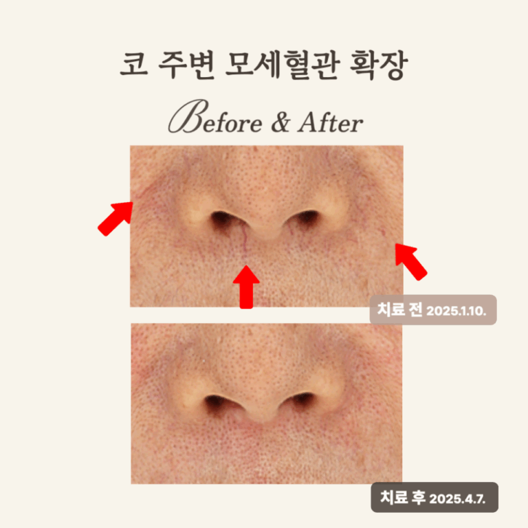 50대, 브이빔 레이저로 홍반과 핏줄 개선 시술 후기