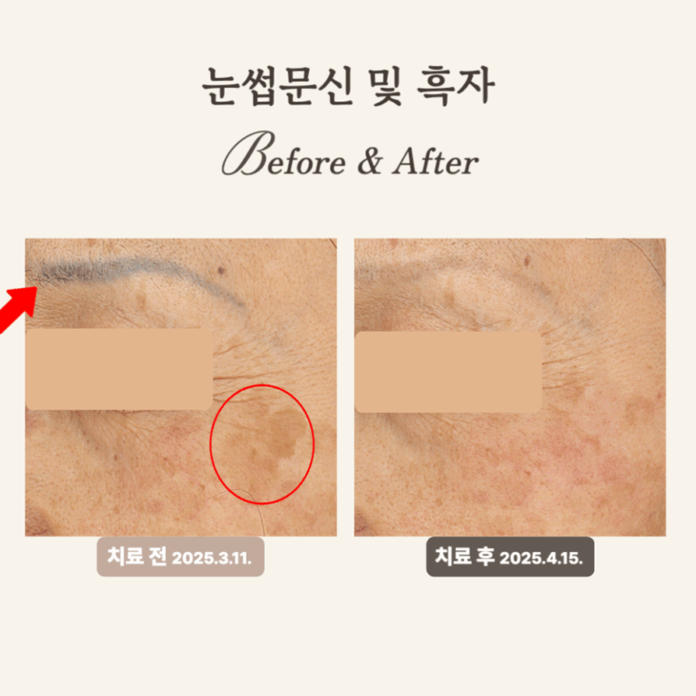 60대 눈썹 문신 제거 후기(레이저 문신제거)