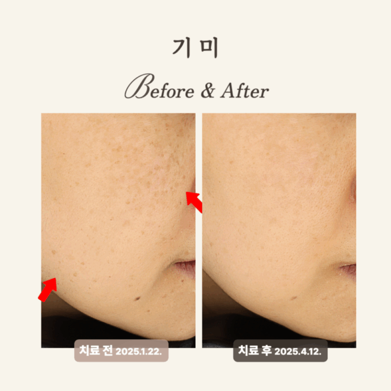 30대 레이저토닝 후기: 기미 개선과 피부톤 균형 회복
