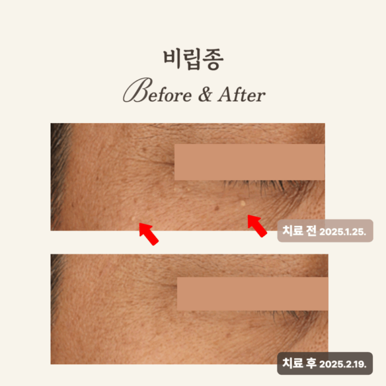 50대 얼굴한판 시술 후기: 비립종, 흑자 개선