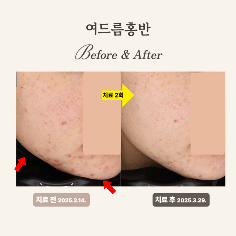 20대 홍반 개선, 브이빔 레이저 치료 후기