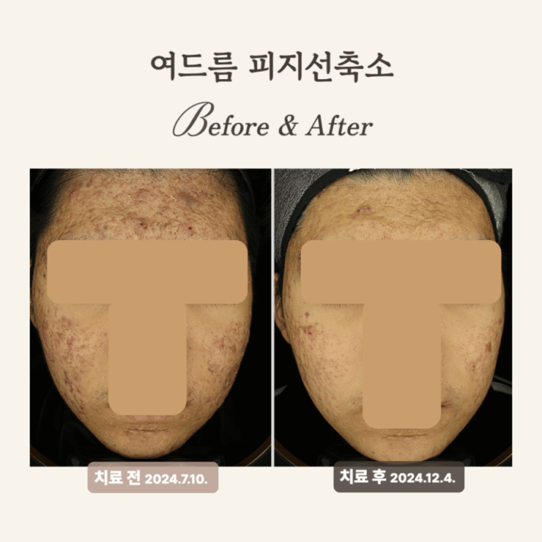 10대 여드름 골드PTT 시술 후 변화 후기