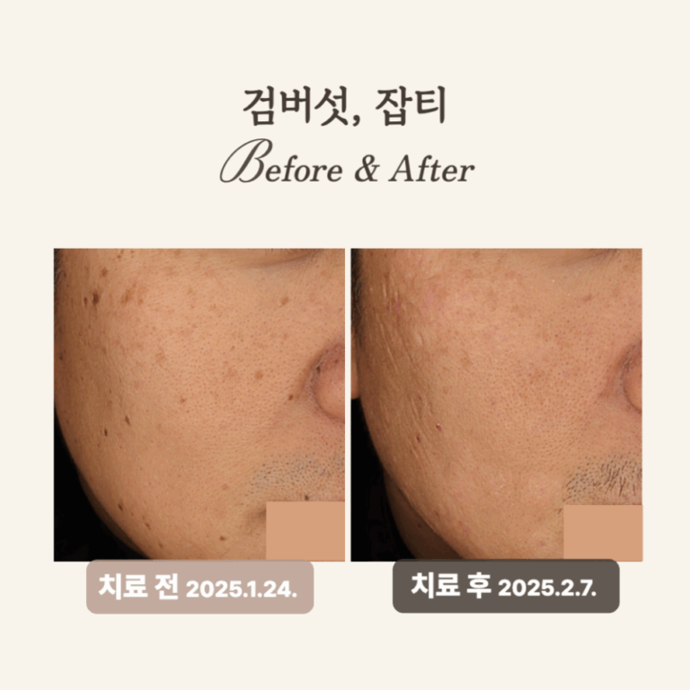 40대 얼굴한판 시술 후기: 잡티 제거와 피부톤 개선