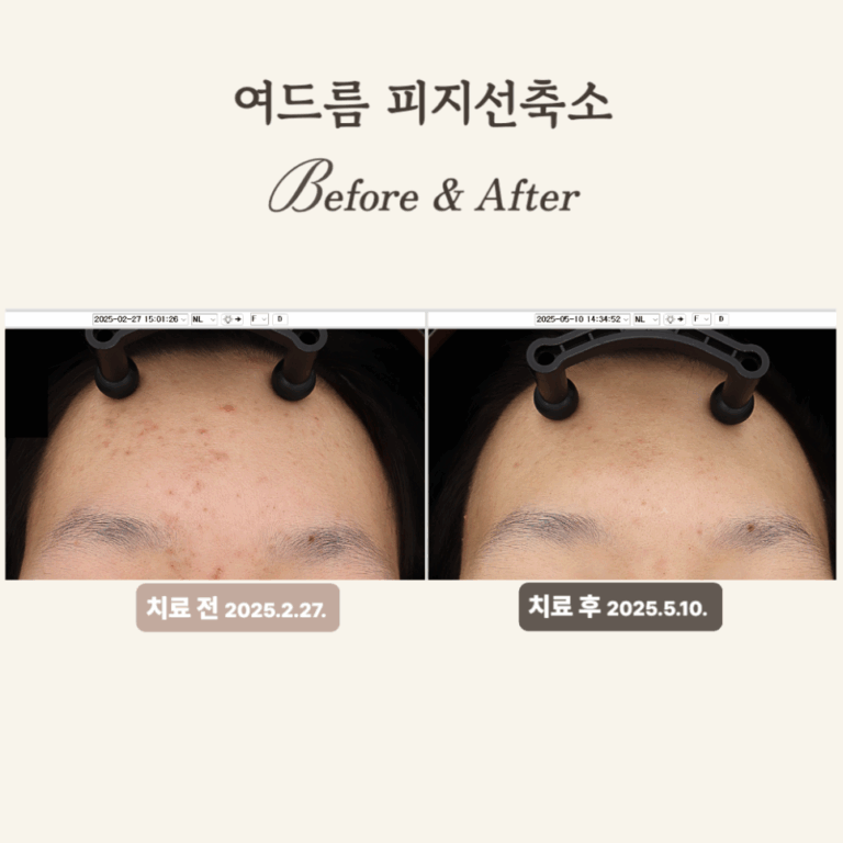 20대 여드름 압출 후 골드PTT로 매끄러워짐