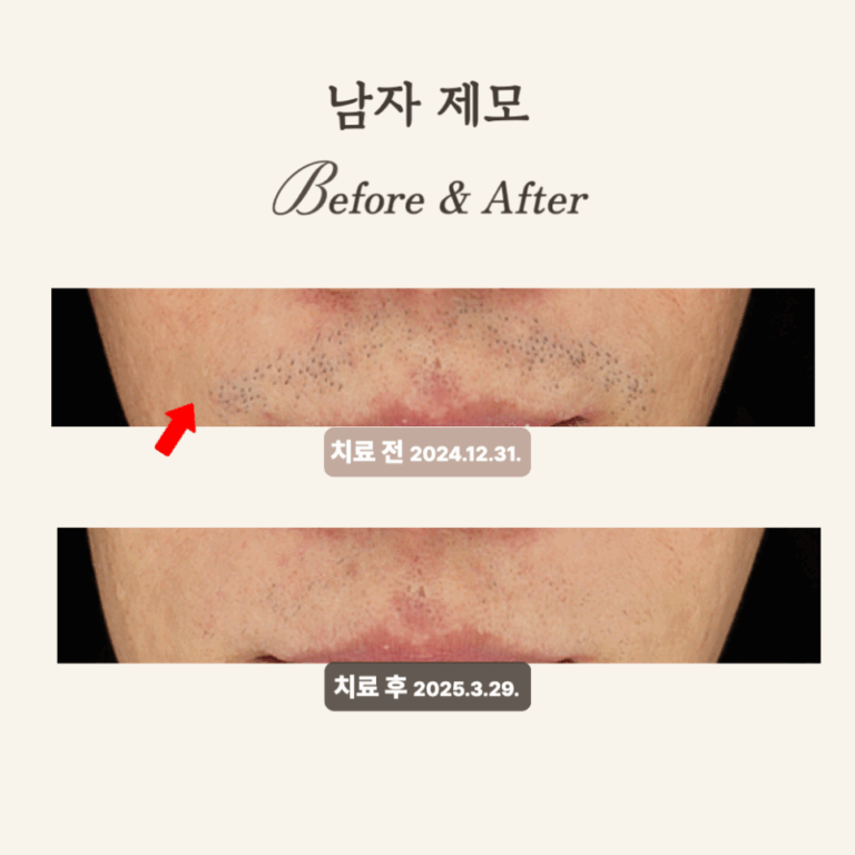 30대 굵은 수염, 제모레이저 치료 후기와 변화