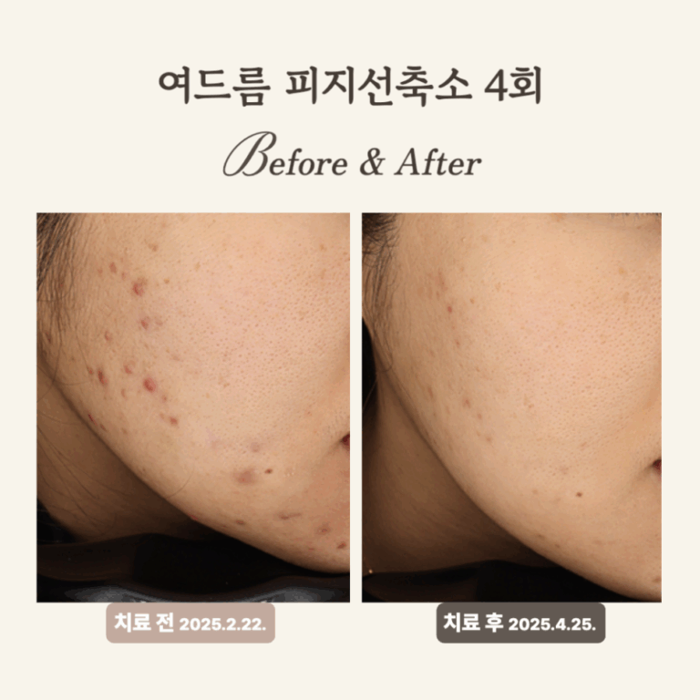 20대 염증성 여드름, 골드PTT+압출 치료 후기