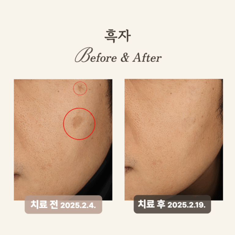 30대 피코토닝 시술 후기: 흑자 제거 후기