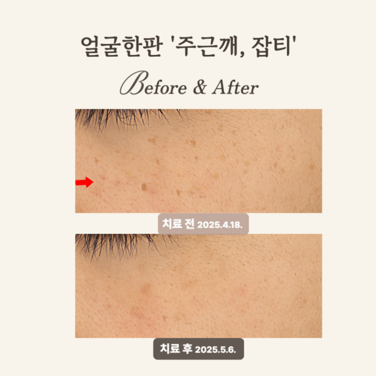 30대, 레이저토닝으로 주근깨 잡티 시술 후기