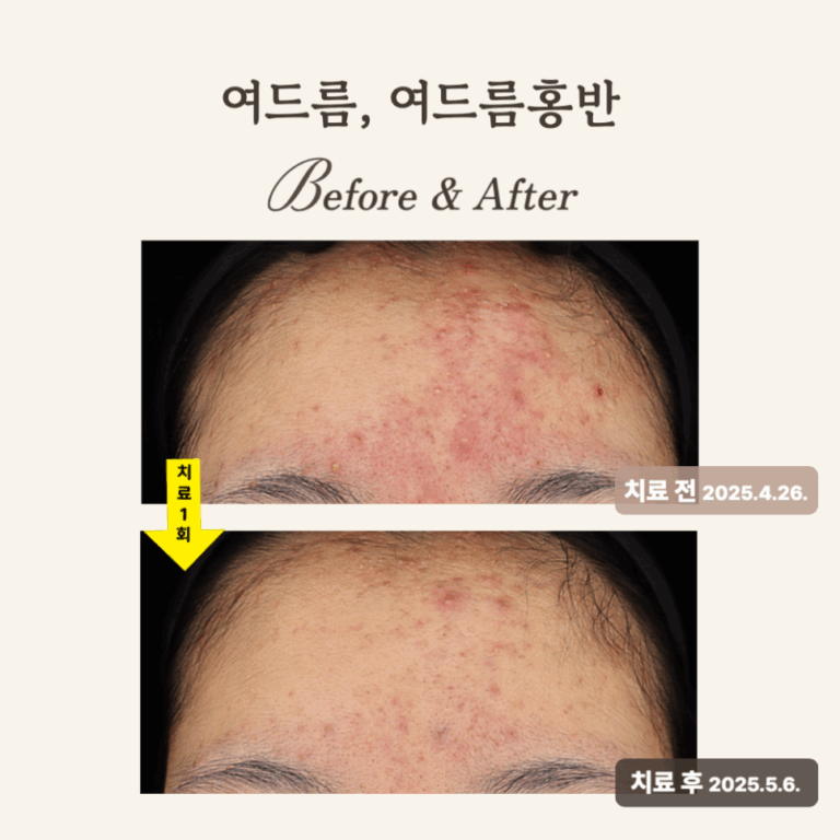 10대 이마 여드름, 브이빔 레이저와 PRP 치료 후기