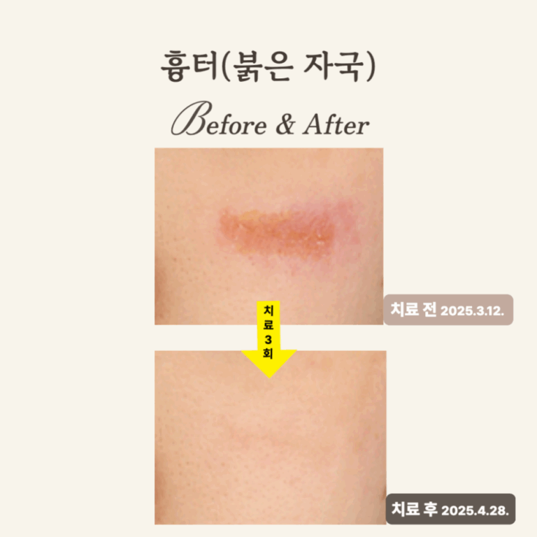 20대, 브이빔 레이저로 붉은 흉터 자국 치료 후기