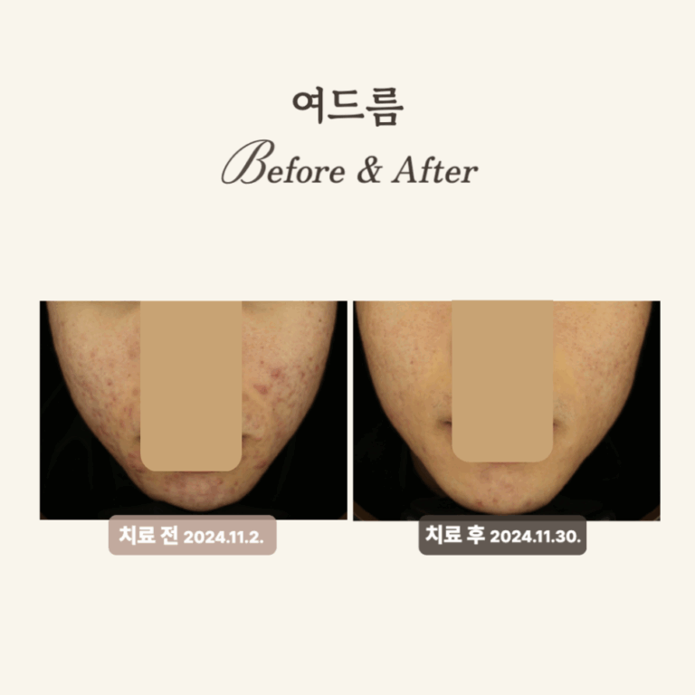 10대의 여드름 흉터, 붉은 자국, 브이빔 레이저 치료 후기