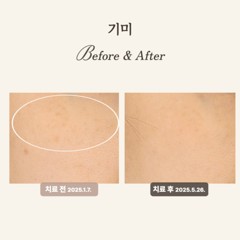 30대 눈가 기미, 레이저 토닝과 PRP시술 후기