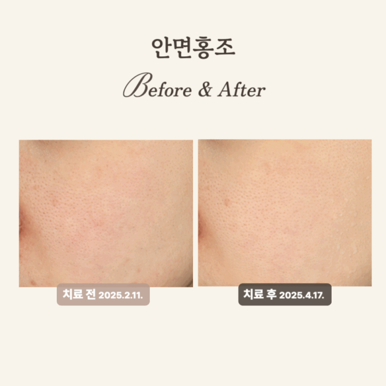 민감성 피부를 위한 브이빔 레이저 치료 후기