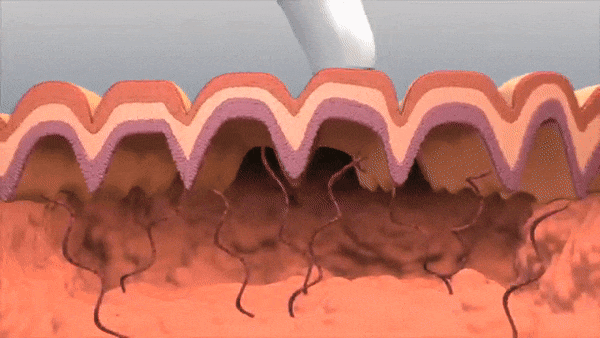 스킨부스터 원리 스킨부스터 원리