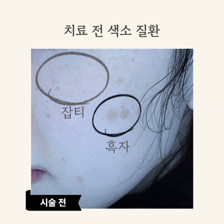 30대 피코 레이저 시술 후기: 잡티 제거와 피부 톤 개선