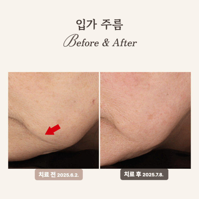 50대 레디어스 시술 후기: 입가 주름과 턱선 복원!