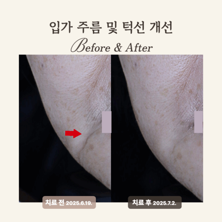 60대 레디어스 시술 후기: 입가 주름 개선과 탄력 회복의 비결