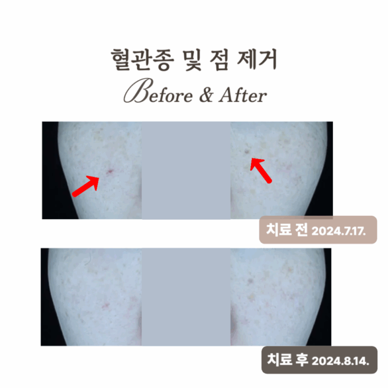 30대 브이빔 레이저 시술 후기: 피부톤 개선과 체리 혈관종 제거