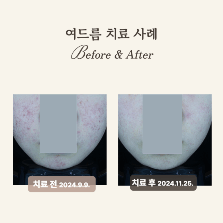10대 염증성 여드름, Gold PTT 시술 후 달라진 피부