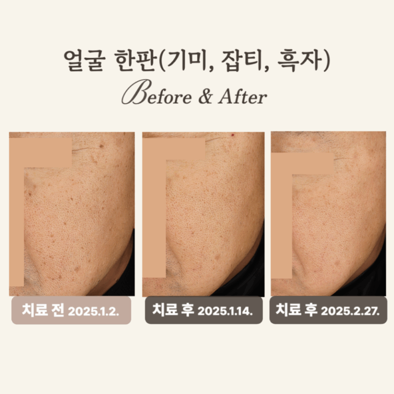 60대 진피형 기미, 레이저 토닝 후기