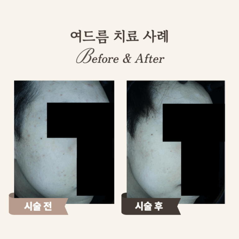 20대 성인 여드름 붉은자국, 브이빔 레이저 시술 후기