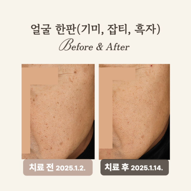 60대 얼굴한판 시술 후기: 피코토닝으로 기미·흑자 개선!