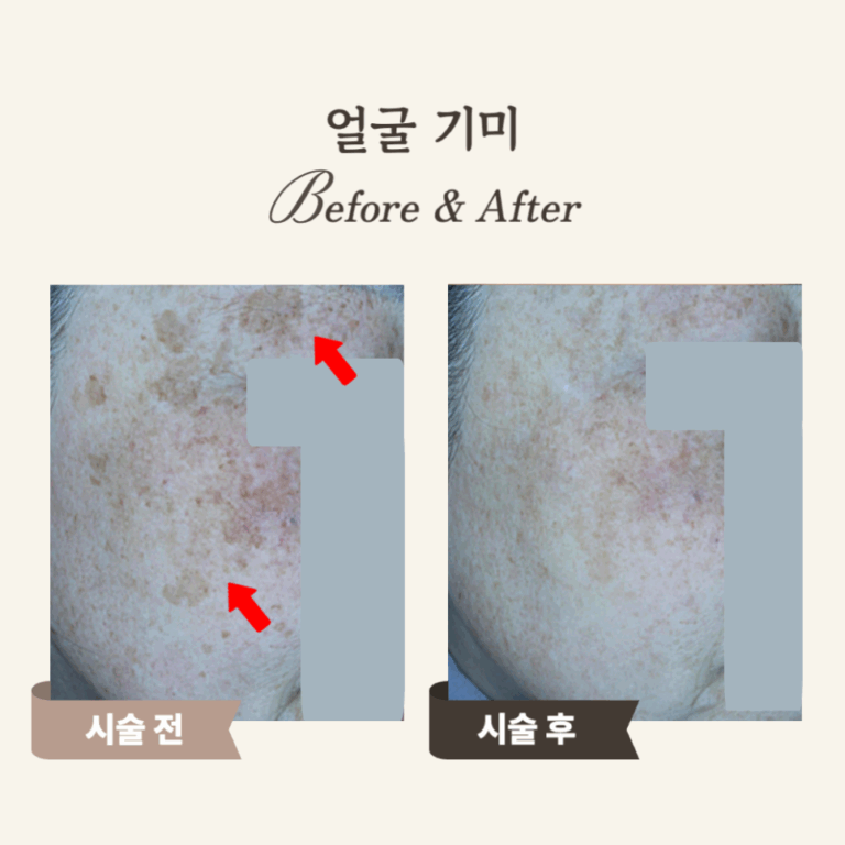60대 레이저 토닝 후기: 기미·잡티 개선 성공